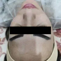 تخفیف ویژه پاکسازی پوست