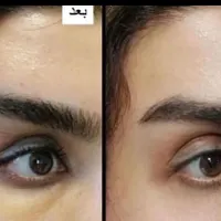 جراحی پلک و بلفاروپلاستی توسط متخصص چشم|خدمات آرایشگری و زیبایی|تهران, افسریه|دیوار