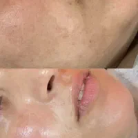 هایفوتراپی و فشیال پوست کره ای|خدمات آرایشگری و زیبایی|یزد, |دیوار