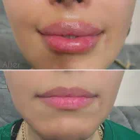 ژل بوتاکس کانتورینگ صورت آنزیم فیلر بینی مزوژل|خدمات آرایشگری و زیبایی|گرمسار, |دیوار