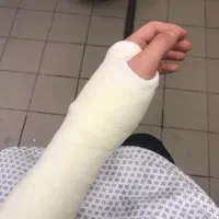 شکسته بندی دررفتگی ناف  دنبالچه تیکه