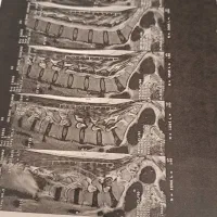 فیزیوتراپی در منزل سکته کایروپرکتیک