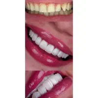 دندانپزشکی ایمپلنت کامپوزیت|خدمات آرایشگری و زیبایی|تهران, صادقیه|دیوار
