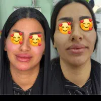 آموزش و تزریق فیلروبوتاکس