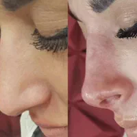 تزریقات تخصصی ژل بوتاکس کوچک کردن بینی بدون جراحی|خدمات آرایشگری و زیبایی|تبریز, |دیوار