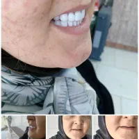 دندانسازی مصنوعی اقساطی با ضمانت