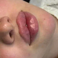 ژل بوتاکس
