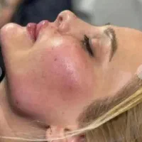 جشنواره تزریق فیلر تزریق چربی بوتاکس تخصصی