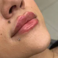 تزریق ژل ،بوتاکس ،لیزر موهای زائد، ساکشن غبعب