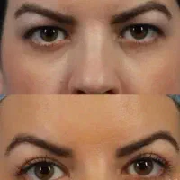 تخفیف ۵۰درصدی بلفارو پلاستی توسط پزشک|خدمات زیبایی و سلامت|کرمانشاه, |دیوار