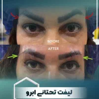 بلفارو/ لیفت صورت و ابرو/غبغب/تزریق چربی با تخفیف|خدمات آرایشگری و زیبایی|مشهد, سجاد شهر|دیوار