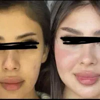 تزریق ژل و بوتاکس بدون درد و کبودی|خدمات آرایشگری و زیبایی|بروجن, |دیوار