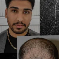 کاشت مو.ابرو.ریش.فول تراکم با شرایط استثنایی|خدمات آرایشگری و زیبایی|شیراز, ستارخان|دیوار