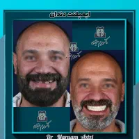 مرکز تخصصی ایمپلنت دندانپزشکی شیراز / تعرفه دولتی