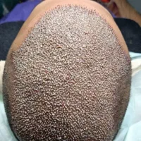 کاشت مو / ریش