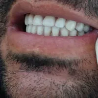 ساخت دندان مصنوعی