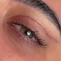 جراحی بلفاروپلاستی پلک و دایرکت