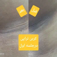 سفید سازی بکینی، جوانسازی پوست پیلینگ(کربن تراپی)|خدمات آرایشگری و زیبایی|مشهد, فرهنگیان (شهرک غرب)|دیوار