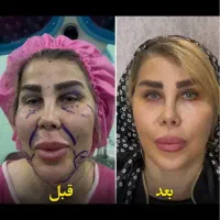 جشنواره تخفیف جراحی زیبایی شقیقه،بلفارو،دایرکت|خدمات آرایشگری و زیبایی|پرند, فاز ۲|دیوار