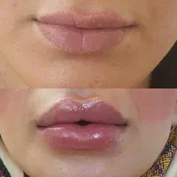 جشنواره تخفیفات ویژه ژل وبوتاکس|خدمات آرایشگری و زیبایی|گنبد کاووس, |دیوار
