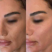تزریق ژل لب روسی فیلربادی بوتاکس لیفت نخ کانتورینگ|خدمات زیبایی و سلامت|تهران, مرزداران|دیوار