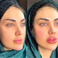 تزریقات و خدمات زیبایی کلینیک بوتاکس ژل مزو PRP
