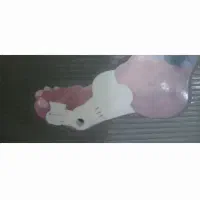 اصلاح کننده انحراف شست پا هالکوس