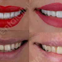قبل از اینکه دیر بشه لبخندت رو زیباتر کن