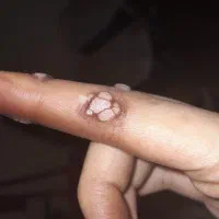 رفع hpv