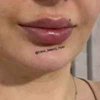 جشنواره تزریق ژل و فیلر بوتاکس مزوتراپی (پزشک)|خدمات آرایشگری و زیبایی|سنندج, |دیوار