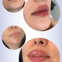 تزریق ژل،لیزر،بوتاکس|خدمات آرایشگری و زیبایی|تهران, یافت‌آباد|دیوار