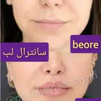 غبغب بوکال لیفت شقیقه سانترال چربی ژل بوتاکس|خدمات آرایشگری و زیبایی|شیراز, قدوسی غربی|دیوار