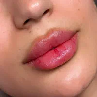 تزریق ژل (فیلر) و بوتاکس|خدمات آرایشگری و زیبایی|شیراز, عادل آباد|دیوار