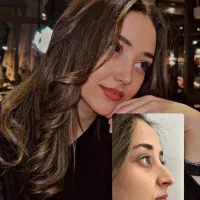 فرصت طلایی جراحی بینی