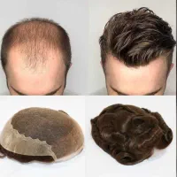 تعویض چسب پروتز  پروتز مو