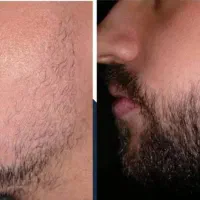 کاشت ممنوع