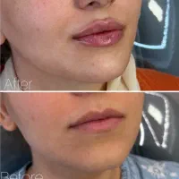 بوتاکس و ژل لب و صورت و بیکینی و باسن و هیپ دیپ
