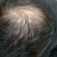 درمان ریزش و کم پشتی
