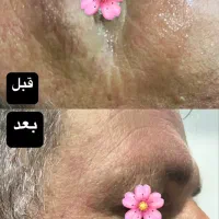 جشنواره زیبایی پوست با هایفوتراپی و آر اف فرکشنال|خدمات آرایشگری و زیبایی|قم, دورشهر|دیوار