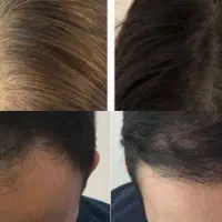 درمان ریزش مو