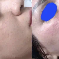 آموزش تخصصی ودرمانی لک تنهادریک جلسه