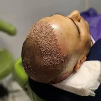 کاشت مو اقساطی باضمانت نامه کتبی مادامالعمر|خدمات آرایشگری و زیبایی|یزد, |دیوار