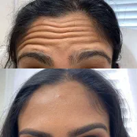 جشنواره ۵۰درصد تخفیف بوتاکس مخصوص خانم ها و آقایان|خدمات آرایشگری و زیبایی|دزفول, |دیوار