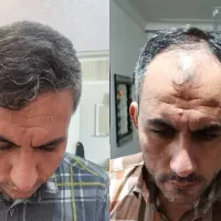 کاشت مو، ابرو، ریش توسط تکنسین15سال تجربه|خدمات آرایشگری و زیبایی|تهران, صادقیه|دیوار