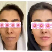 چاقی صورت و بدن تضمینی