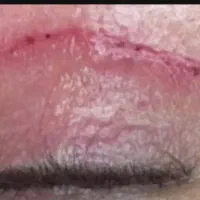 تکنیک جدید درمانی خاویار تراپی.اگززوم تراپی.