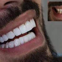 کامپوزیت و سرامیک دندان