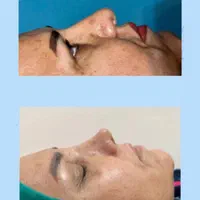 عمل بینی بندرعباس،اقساطی،باکیفیت و تضمین|خدمات آرایشگری و زیبایی|بندرعباس, |دیوار