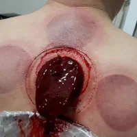 حجامت فصد زالو درمانی بادکش گرم و سرد در محل شما|خدمات آرایشگری و زیبایی|اسلام‌شهر, مسکن مهر اسلاشهر (شهرک امام خمینی)|دیوار