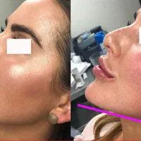 تزریق ژل بوتاکس فیلر تخفیف ویژه|خدمات آرایشگری و زیبایی|تهران, سبلان (لشگر)|دیوار